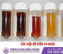 Nước Tiểu Màu Nâu Đỏ Ở Nữ